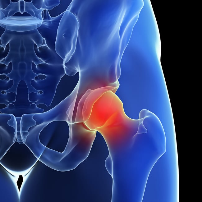 Orthopedic Core Curriculum - Hip