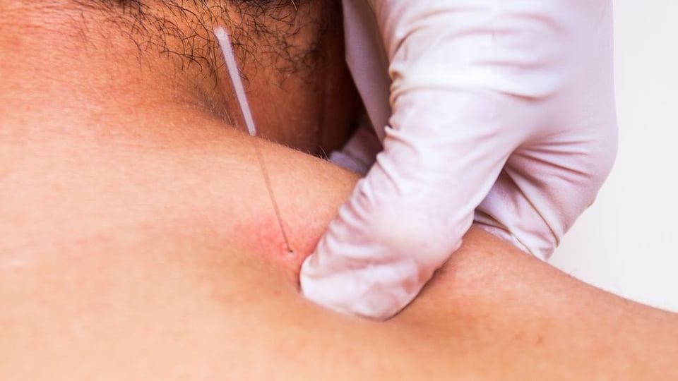 Dry Needling Evidence-Based Concepts and Essential Skills